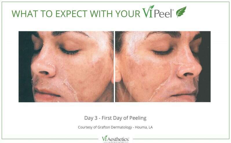 VI Precision Peel for thicker, rougher skin