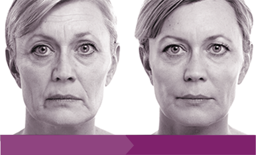 What’s the Difference Between Fillers vs Wrinkle Reducers?