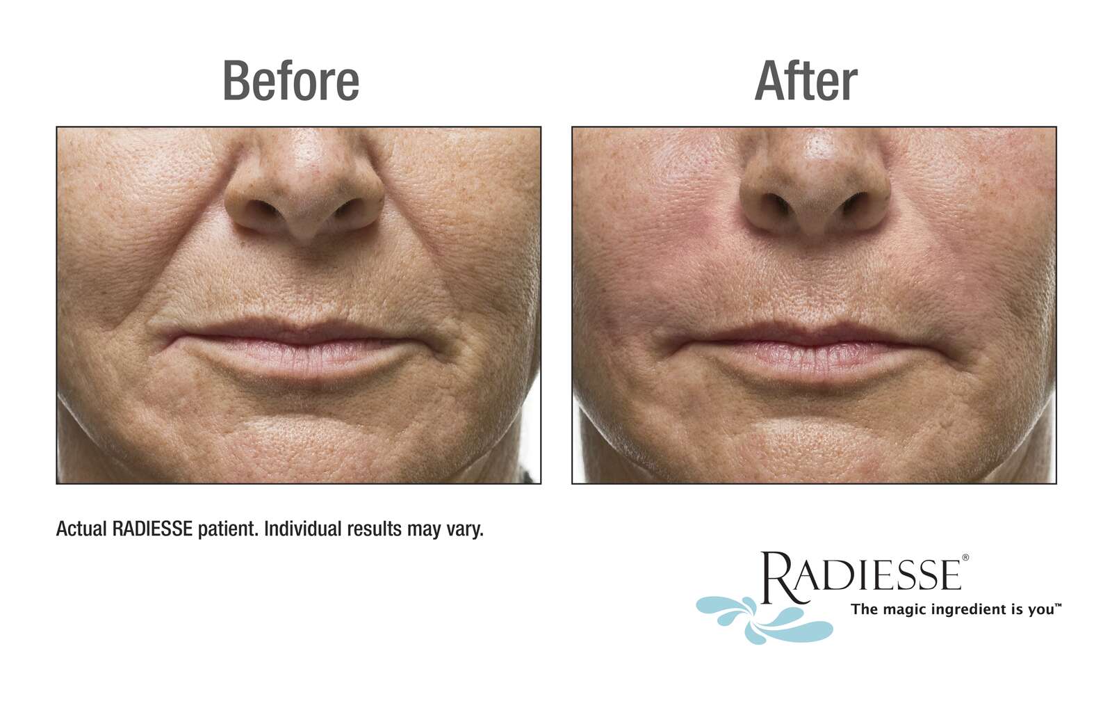 Radiesse – A More Youthful Appearance