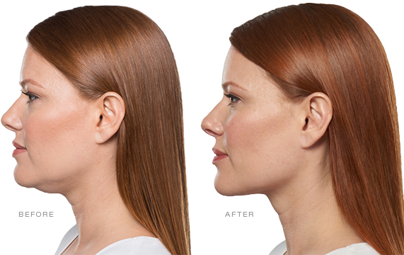 Kybella – What to Expect