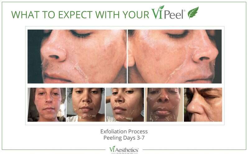 What is the VI Purify Peel for Acne?