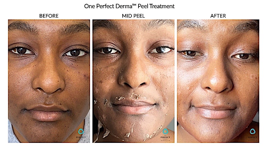 Perfect Derma Peel for Pigment and Wrinkles